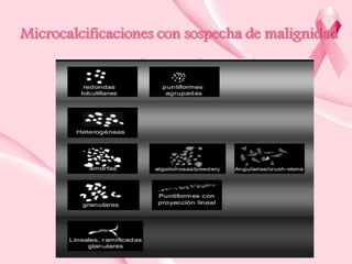 Microcalcificaciones con sospecha de malignidad

 