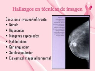 Hallazgos en técnicas de imagen
Carcinoma invasivo/infiltrante
• Nódulo
• Hipoecoico
• Márgenes espiculados
• Mal definidos
• Con angulacion
• Sombra posterior
• Eje vertical mayor al horizontal

 