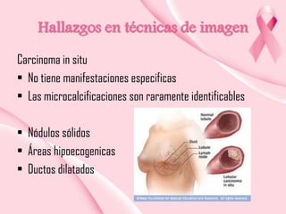 Hallazgos en técnicas de imagen
Carcinoma in situ
• No tiene manifestaciones especificas
• Las microcalcificaciones son raramente identificables
• Nódulos sólidos
• Áreas hipoecogenicas
• Ductos dilatados

 