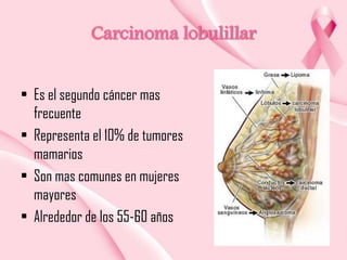 Carcinoma lobulillar
• Es el segundo cáncer mas
frecuente
• Representa el 10% de tumores
mamarios
• Son mas comunes en mujeres
mayores
• Alrededor de los 55-60 años

 