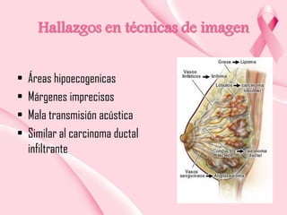 Hallazgos en técnicas de imagen
•
•
•
•

Áreas hipoecogenicas
Márgenes imprecisos
Mala transmisión acústica
Similar al carcinoma ductal
infiltrante

 