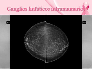 Ganglios linfáticos intramamarios

 