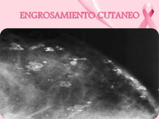 ENGROSAMIENTO CUTANEO

 