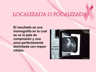 LOCALIZADA O FOCALIZADA
El resultado es una
mamografía en la cual
se ve la pala de
compresión y una
zona perfectamente
delimitada con mayor
nitidez.

 