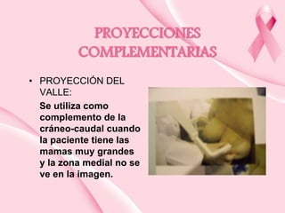 PROYECCIONES
COMPLEMENTARIAS
• PROYECCIÓN DEL
VALLE:
Se utiliza como
complemento de la
cráneo-caudal cuando
la paciente tiene las
mamas muy grandes
y la zona medial no se
ve en la imagen.

 