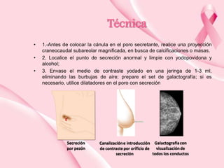 Técnica
•
•

•

1.-Antes de colocar la cánula en el poro secretante, realice una proyección
craneocaudal subareolar magnificada, en busca de calcificaciones o masas.
2. Localice el punto de secreción anormal y limpie con yodopovidona y
alcohol;
3. Envase el medio de contraste yodado en una jeringa de 1-3 ml,
eliminando las burbujas de aire; prepare el set de galactografía; si es
necesario, utilice dilatadores en el poro con secreción

 