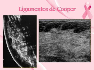 Ligamentos de Cooper

 