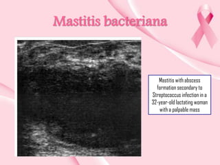 Mastitis bacteriana

Mastitis with abscess
formation secondary to
Streptococcus infection in a
32-year-old lactating woman
with a palpable mass

 