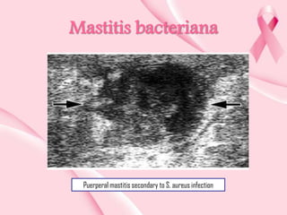 Mastitis bacteriana

Puerperal mastitis secondary to S. aureus infection

 