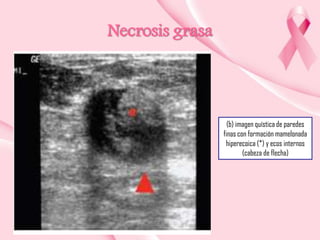 Necrosis grasa

(b) imagen quística de paredes
finas con formación mamelonada
hiperecoica (*) y ecos internos
(cabeza de flecha)

 