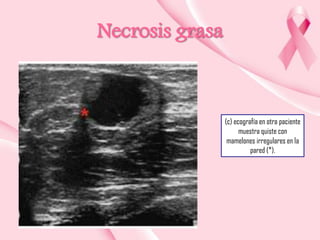 Necrosis grasa

(c) ecografía en otra paciente
muestra quiste con
mamelones irregulares en la
pared (*).

 