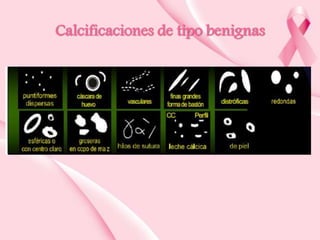Calcificaciones de tipo benignas

 