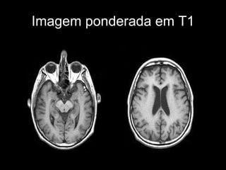 Imagem ponderada em T1 