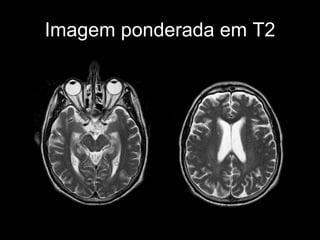 Imagem ponderada em T2 