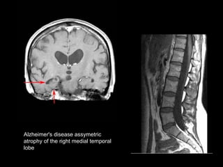 Alzheimer's disease   assymetric  atrophy of the right medial temporal  lobe   