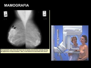 MAMOGRAFIA 