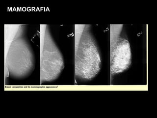 MAMOGRAFIA 