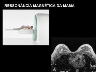 RESSONÂNCIA MAGNÉTICA DA MAMA 