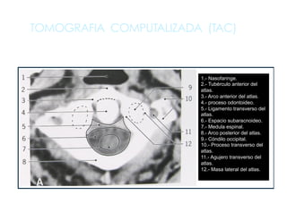 TOMOGRAFIA COMPUTALIZADA (TAC)
1.- Nasofaringe.
2.- Tubérculo anterior del
atlas.
3.- Arco anterior del atlas.
4.- proceso odontoideo.
5.- Ligamento transverso del
atlas.
6.- Espacio subaracnoideo.
7.- Medula espinal.
8.- Arco posterior del atlas.
9.- Cóndilo occipital.
10.- Proceso transverso del
atlas.
11.- Agujero transverso del
atlas.
12.- Masa lateral del atlas.
 