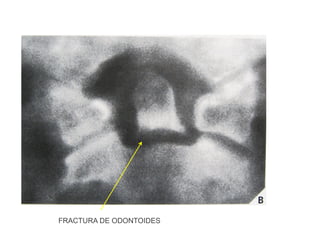 TC: Corte Coronal
FRACTURA DE ODONTOIDES
 
