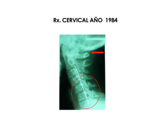 Rx. CERVICAL AÑO 1984
 