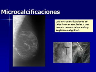 Microcalcificaciones
Las microcalcificaciones se
debe buscar asociadas a una
masa o no asociadas a ella y
sugieren malignidad.
 