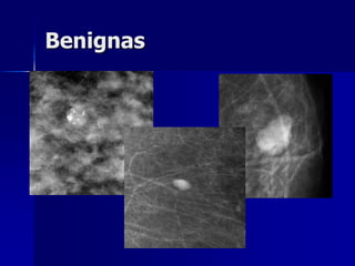 Benignas
 