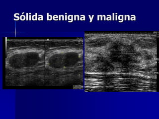 Sólida benigna y maligna
 