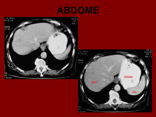 ABDOME
 