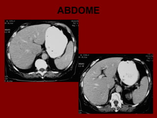 ABDOME
 