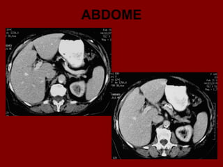 ABDOME
 