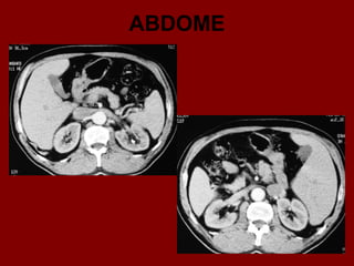 ABDOME
 