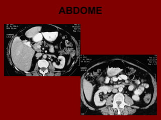 ABDOME
 