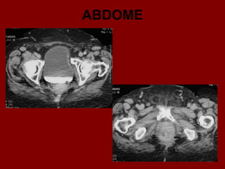 ABDOME
 