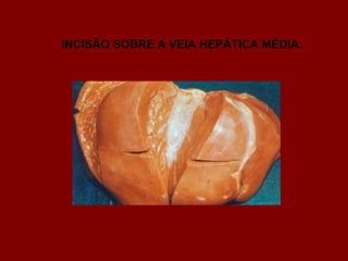 INCISÃO SOBRE A VEIA HEPÁTICA MÉDIA.
 