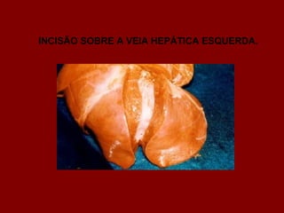 INCISÃO SOBRE A VEIA HEPÁTICA ESQUERDA.
 