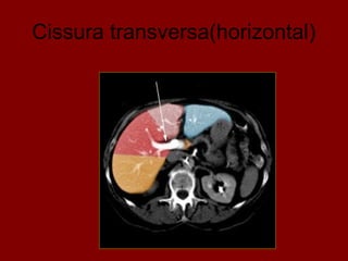 Cissura transversa(horizontal)
 