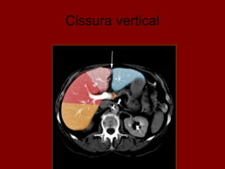 Cissura vertical
 