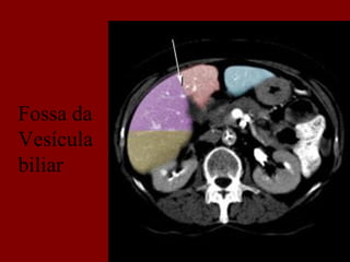 Fossa da
Vesícula
biliar
 