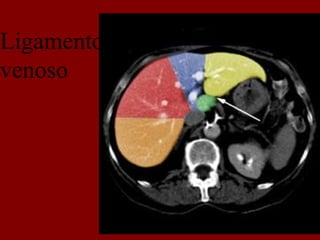 Ligamento
venoso
 
