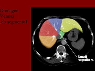 Drenagen
Venosa
do segmento1
 