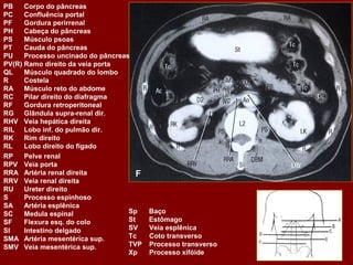 PB    Corpo do pâncreas
PC    Confluência portal
PF    Gordura perirrenal
PH    Cabeça do pâncreas
PS    Músculo psoas
PT    Cauda do pâncreas
PU    Processo uncinado do pâncreas
PV(R) Ramo direito da veia porta
QL    Músculo quadrado do lombo
R     Costela
RA    Músculo reto do abdome
RC    Pilar direito do diafragma
RF    Gordura retroperitoneal
RG Glândula supra-renal dir.
RHV Veia hepática direita
RIL Lobo inf. do pulmão dir.
RK    Rim direito
RL    Lobo direito do fígado
RP    Pelve renal
RPV Veia porta
RRA Artéria renal direita             F
RRV Veia renal direita
RU    Ureter direito
S     Processo espinhoso
SA    Artéria esplênica
SC    Medula espinal               Sp     Baço
SF    Flexura esq. do colo         St     Estômago
SI    Intestino delgado            SV     Veia esplênica
SMA Artéria mesentérica sup.       Tc     Coto transverso
SMV Veia mesentérica sup.          TVP    Processo transverso
                                   Xp     Processo xifóide
 