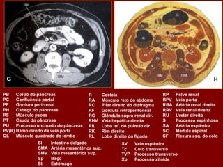 G                                                                                                   H

PB    Corpo do pâncreas               R         Costela                      RP    Pelve renal
PC    Confluência portal              RA        Músculo reto do abdome       RPV   Veia porta
PF    Gordura perirrenal              RC        Pilar direito do diafragma   RRA   Artéria renal direita
PH    Cabeça do pâncreas              RF        Gordura retroperitoneal      RRV   Veia renal direita
PS    Músculo psoas                   RG        Glândula supra-renal dir.    RU    Ureter direito
PT    Cauda do pâncreas               RHV       Veia hepática direita        S     Processo espinhoso
PU    Processo uncinado do pâncreas   RIL       Lobo inf. do pulmão dir.     SA    Artéria esplênica
PV(R) Ramo direito da veia porta      RK        Rim direito                  SC    Medula espinal
QL    Músculo quadrado do lombo       RL        Lobo direito do fígado       SF    Flexura esq. do colo
               SI    Intestino delgado                   SV     Veia esplênica
               SMA   Artéria mesentérica sup.            Tc     Coto transverso
               SMV   Veia mesentérica sup.               TVP    Processo transverso
               Sp    Baço                                Xp     Processo xifóide
               St    Estômago
 
