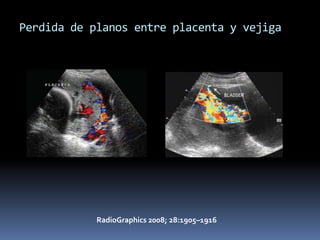 Perdida de planos entre placenta y vejiga




            RadioGraphics 2008; 28:1905–1916
 