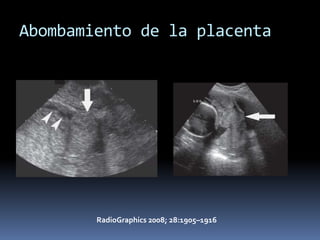 Abombamiento de la placenta




        RadioGraphics 2008; 28:1905–1916
 