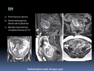 RM
a) Prominencia uterina
b) Senal heterogenea
   dentro de la placenta
c) Bandas hipointensas
   intraplacentarias en T2.




                       RadioGraphics 2008; 28:1905–1916
 