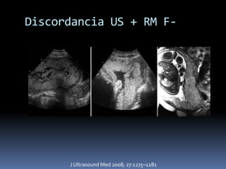 Discordancia US + RM F-




      J Ultrasound Med 2008; 27:1275–1281
 