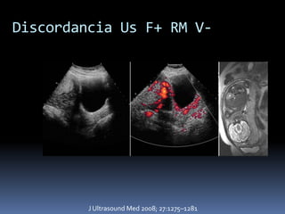 Discordancia Us F+ RM V-




         J Ultrasound Med 2008; 27:1275–1281
 