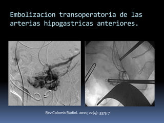 Embolizacion transoperatoria de las
arterias hipogastricas anteriores.




         Rev Colomb Radiol. 2011; 22(4): 3375-7
 