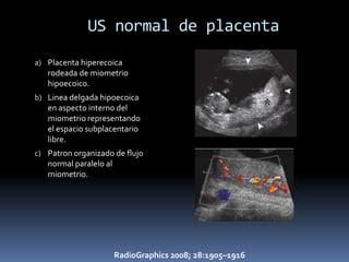 US normal de placenta
a) Placenta hiperecoica
   rodeada de miometrio
   hipoecoico.
b) Linea delgada hipoecoica
   en aspecto interno del
   miometrio representando
   el espacio subplacentario
   libre.
c) Patron organizado de flujo
   normal paralelo al
   miometrio.




                     RadioGraphics 2008; 28:1905–1916
 